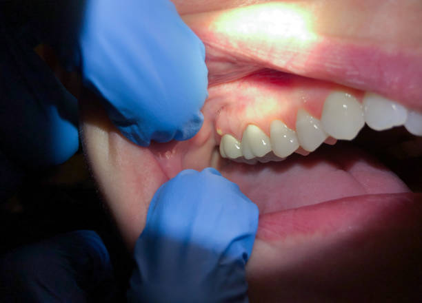 Best Knocked-Out Tooth Emergency  in Sylacauga, AL